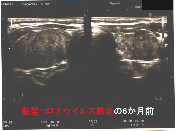 新型コロナウイルス肺炎をおこす6か月前の橋本病 超音波(エコー)画像