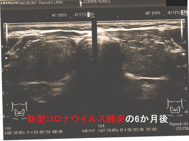新型コロナウイルス肺炎発症6か月後の橋本病　超音波(エコー)画像