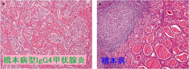 橋本病型IgG4甲状腺炎と橋本病の組織像の比較