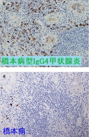 橋本病型IgG4甲状腺炎と橋本病の比較　IgG4免疫染色炎