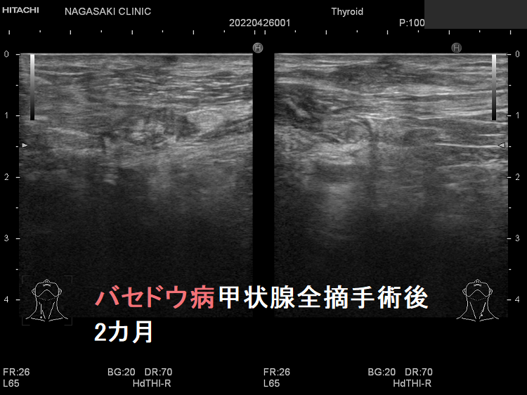 バセドウ病甲状腺全摘出後 2カ月 超音波(エコー)画像