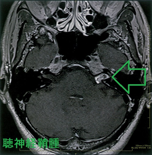 聴神経鞘腫 造影MRI T1画像