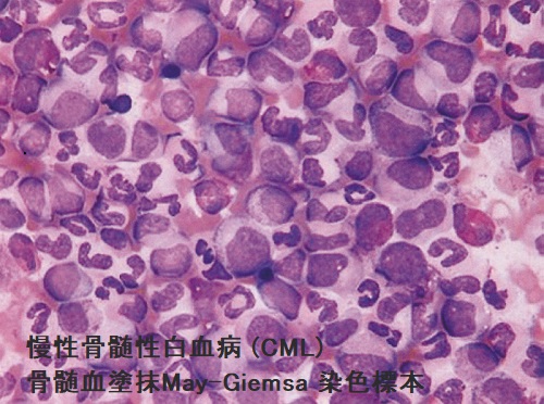 慢性骨髄性白血病(CML)  骨髄血塗抹May-Giemsa 染色標本