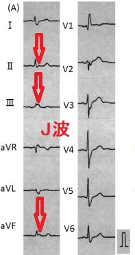 甲状腺機能亢進症 バセドウ病に伴う冠攣縮性狭心症による心室細動(Vf) 最初からJ波を有する心電図
