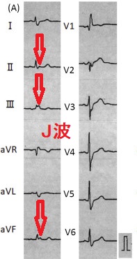 甲状腺機能亢進症 バセドウ病に伴う冠攣縮性狭心症による心室細動(Vf) 最初からJ波を有する心電図 甲状腺機能亢進症 バセドウ病に伴う冠攣縮性狭心症による心室細動(Vf) 最初からJ波を有する心電図