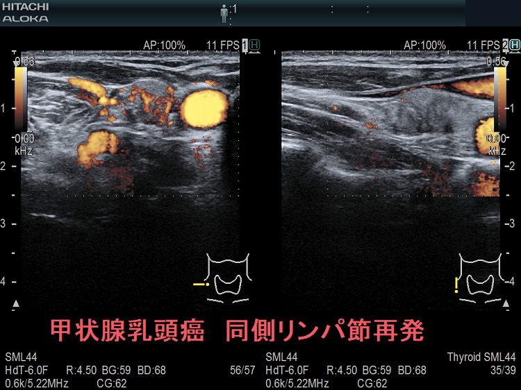 甲状腺乳頭癌の同側（切除した側）のリンパ節再発 超音波(エコー)画像 ドプラーモード