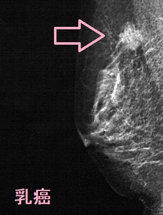 乳癌 マンモグラフィー