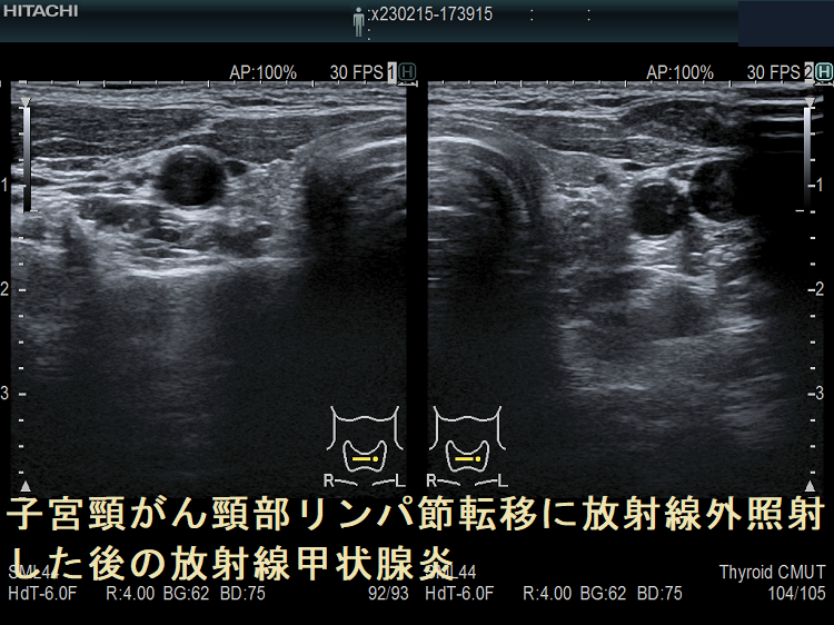 子宮頸がん頸部リンパ節転移に放射線外照射した後の放射線甲状腺炎 超音波(エコー)画像
