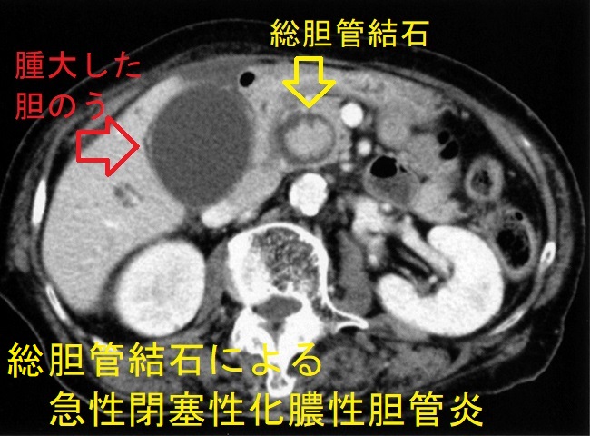 胆管結石による急性閉塞性化膿性胆管炎　CT画像1