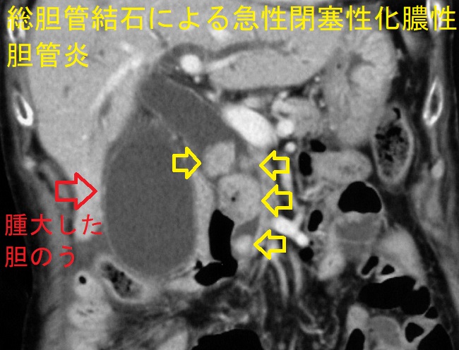 胆管結石による急性閉塞性化膿性胆管炎 CT画像2