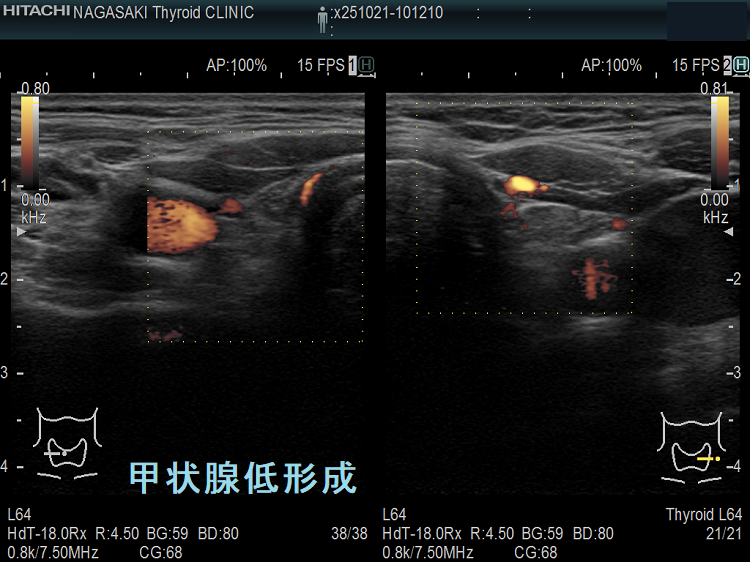 甲状腺低形成 ドプラーモード 甲状腺低形成 ドプラーモード