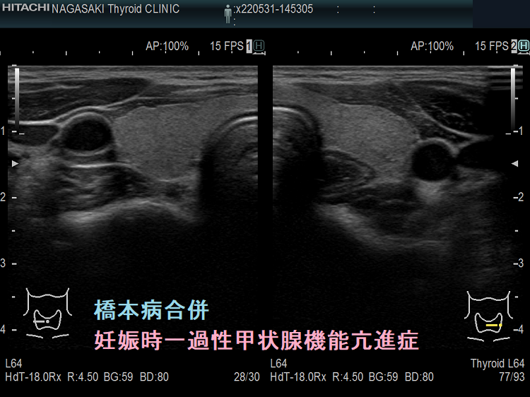 橋本病合併妊娠時一過性甲状腺機能亢進症の超音波(エコー)画像