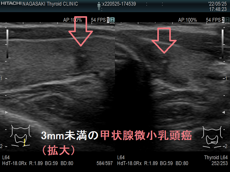 3mm未満の甲状腺微小乳頭癌 (拡大) 超音波(エコー)画像