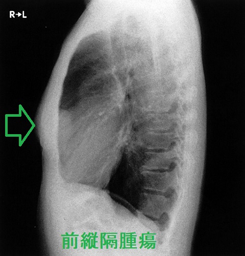 前縦隔腫瘍 胸部単純レントゲン写真