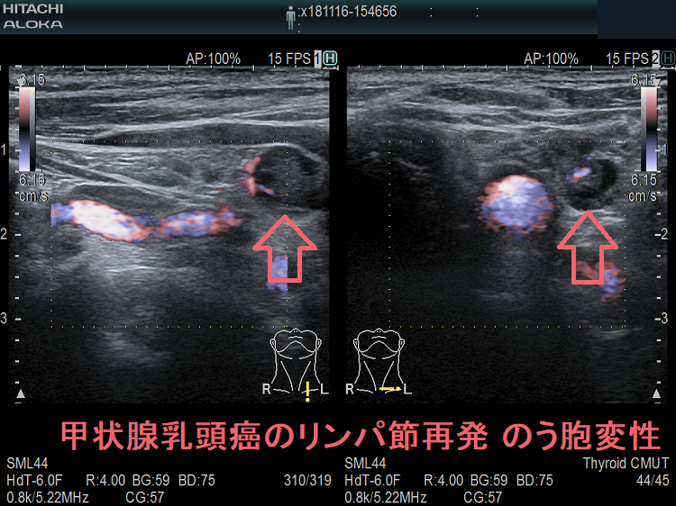 甲状腺乳頭癌の左鎖骨上窩 リンパ節再発 のう胞変性 超音波(エコー)画像ドプラーモード