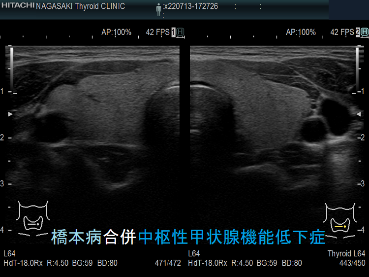 橋本病合併中枢性甲状腺機能低下症　超音波(エコー)画像
