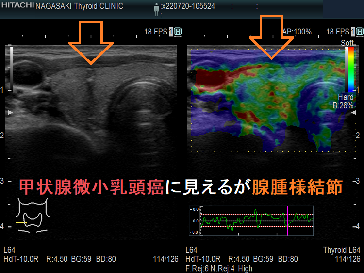 甲状腺微小乳頭癌に見えるが腺腫様結節 超音波(エコー)画像　エラストグラフィー