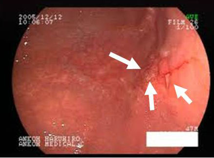 胃MALTリンパ腫 内視鏡画像