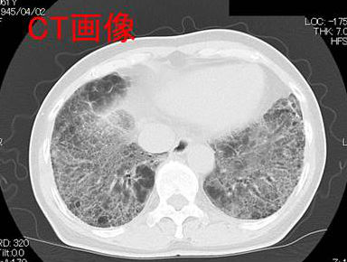 メソトレキセート間質性肺炎　CT画像