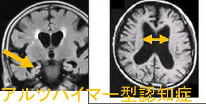 アルツハイマー型認知症　MRI画像