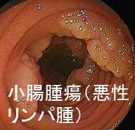 小腸腫瘍（悪性リンパ腫）