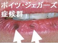 ポイツ・ジェガーズ症候群 ポイツ・ジェガーズ症候群