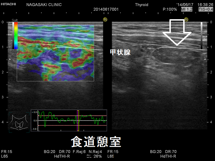食道憩室 甲状腺超音波(エコー)画像 エラストグラフィー