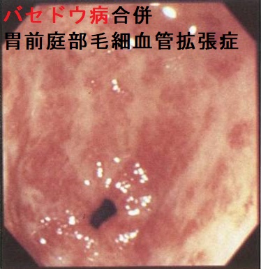 バセドウ病合併胃前庭部毛細血管拡張症