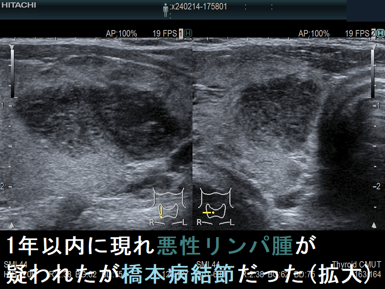 1年以内に現れ悪性リンパ腫が疑われたが橋本病結節だった (拡大) 1年以内に現れ悪性リンパ腫が疑われたが橋本病結節だった (拡大)