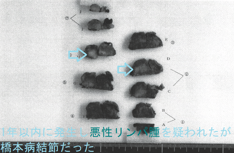 1年以内に発生し悪性リンパ腫を疑われたが橋本病結節だった 摘出標本 1年以内に発生し悪性リンパ腫を疑われたが橋本病結節だった 摘出標本