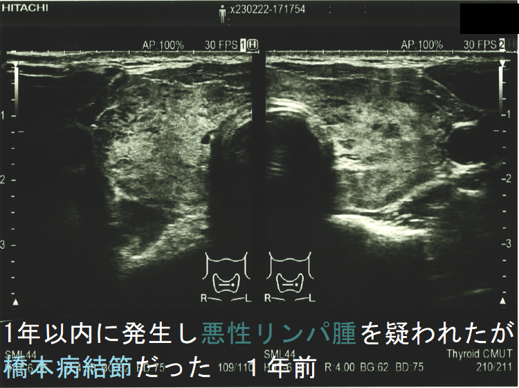 1年以内に現れ悪性リンパ腫が疑われたが橋本病結節だった 1年前 (水平断) 1年以内に現れ悪性リンパ腫が疑われたが橋本病結節だった 1年前 (水平断)