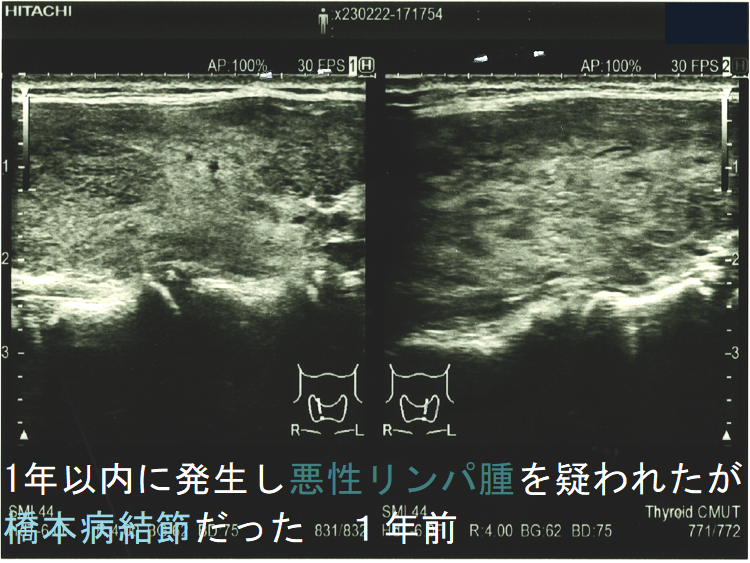 1年以内に現れ悪性リンパ腫が疑われたが橋本病結節だった 1年前 (矢状断) 1年以内に現れ悪性リンパ腫が疑われたが橋本病結節だった 1年前 (矢状断)