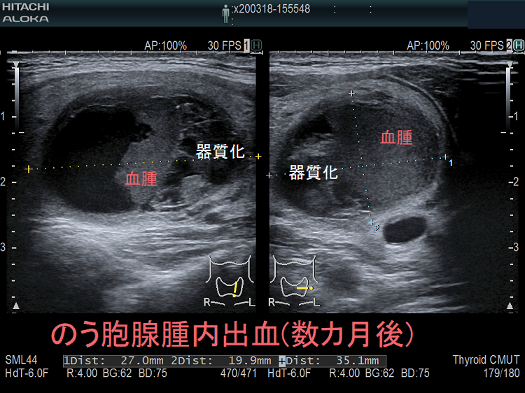 のう胞腺腫内出血(数カ月後) 超音波（エコー）画像