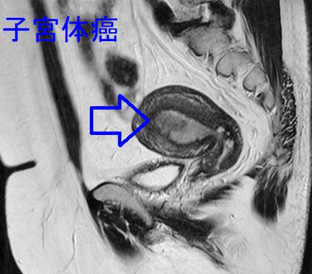 子宮内膜がん(子宮体癌) MRI T2強調画像