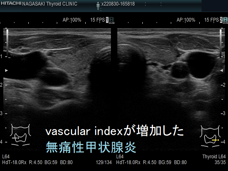 vascular index(血流指数)が増加した無痛性甲状腺炎 Bモード画像