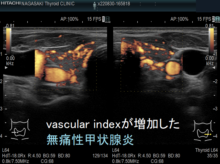 vascular index(血流指数)が増加した急性期の無痛性甲状腺炎のドプラーモード
