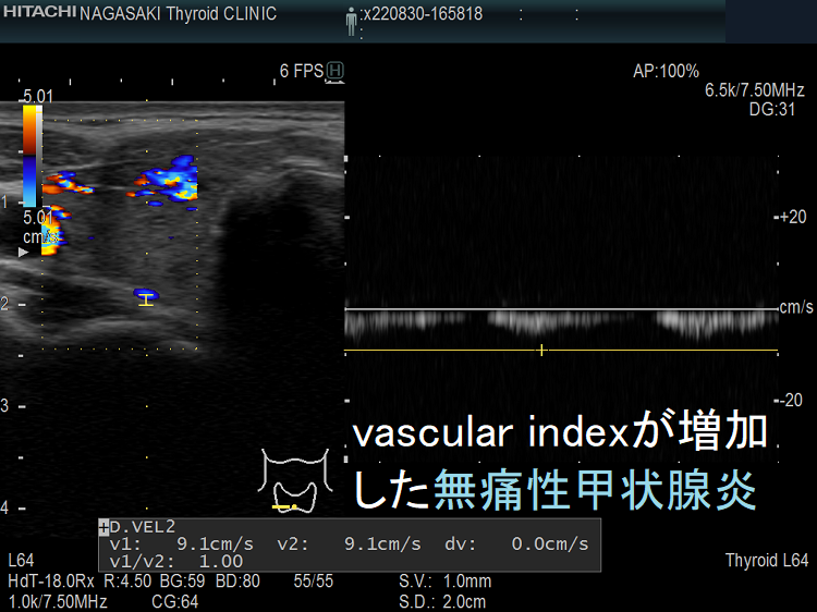 vascular index(血流指数)が増加した急性期の無痛性甲状腺炎の下甲状腺動脈の収縮期最大血流速度(ITA-PSV)