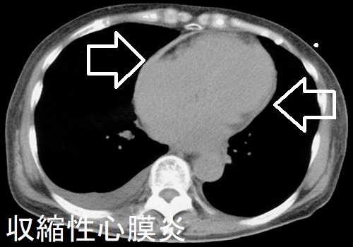収縮性心膜炎 CT 画像