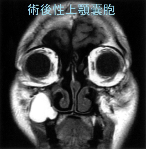 右術後性上顎嚢胞 MRI T1強調画像