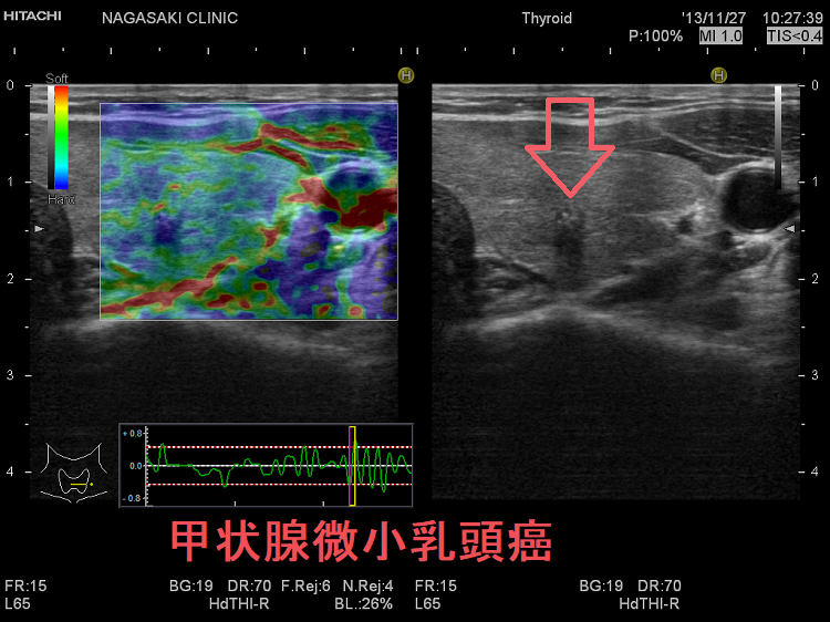 甲状腺微小乳頭癌 超音波(エコー)画像