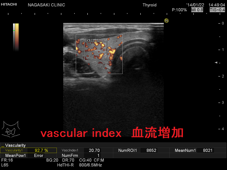 vascular index 血流増加