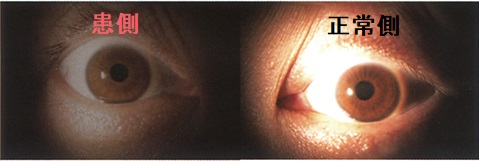 右眼外傷性視神経症 対光反射1