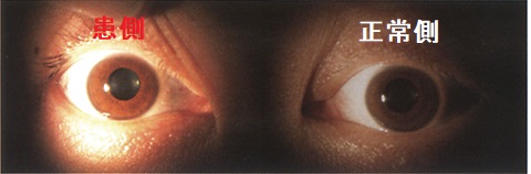 右眼外傷性視神経症 対光反射2
