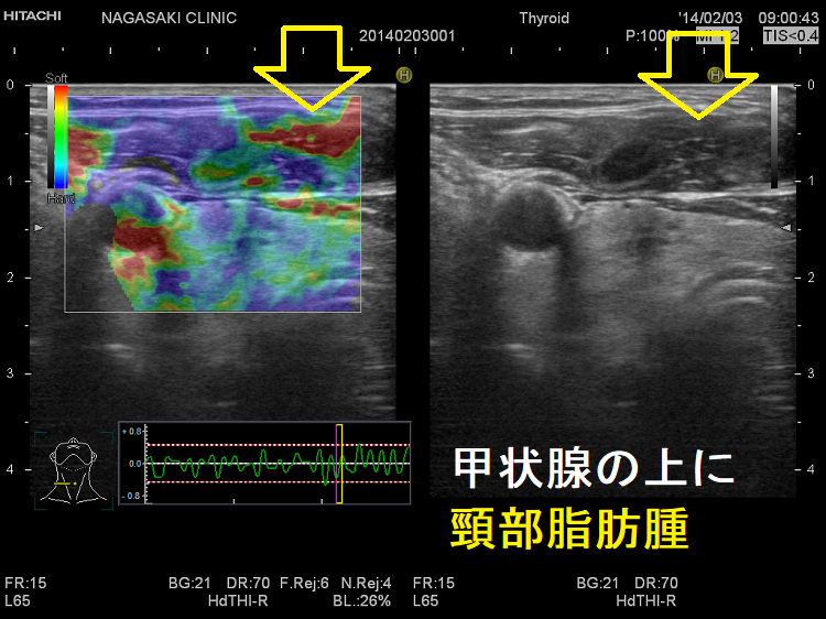 甲状腺の上に頸部脂肪腫 超音波(エコー)画像 エラストグラフィー