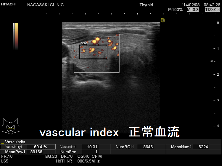 vascular index 正常血流