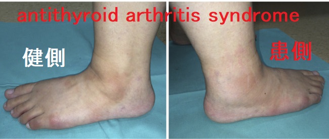 antithyroid arthritis syndrome