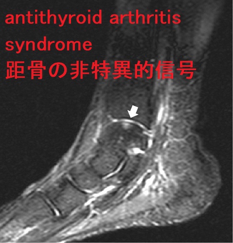 antithyroid arthritis syndrome MRI画像