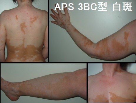 APS(多腺性自己免疫症候群)3BC型 白斑