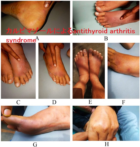 カルビマゾールによるantithyroid arthritis syndrome