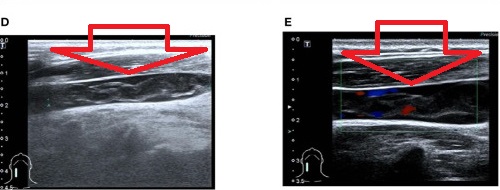 甲状腺微小乳頭癌と頸部リンパ節転移のマイクロ波アブレーション後 内頸静脈血栓症2